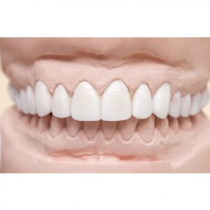 Hollywood Smile Makeover