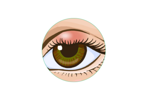 Homeopathy for Eye Cyst in Dubai