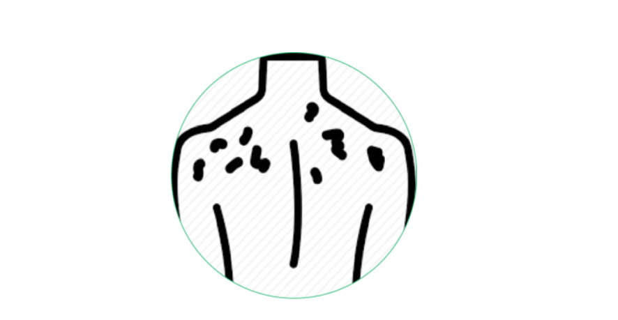 Homeopathy treatment for Eczema in Dubai