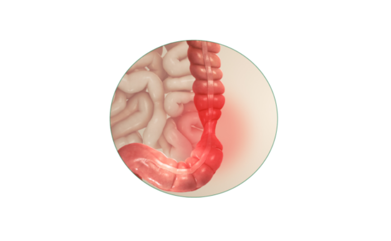 Homeopathy treatment for Irritable Bowel Syndrome