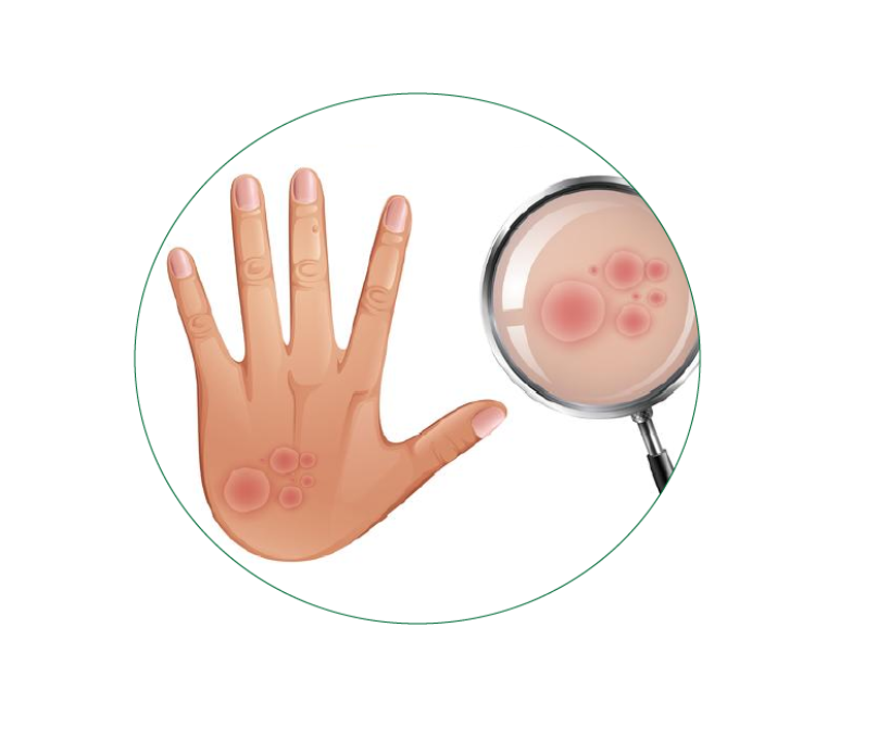 Homeopathy treatment for Lichen Planus in Dubai