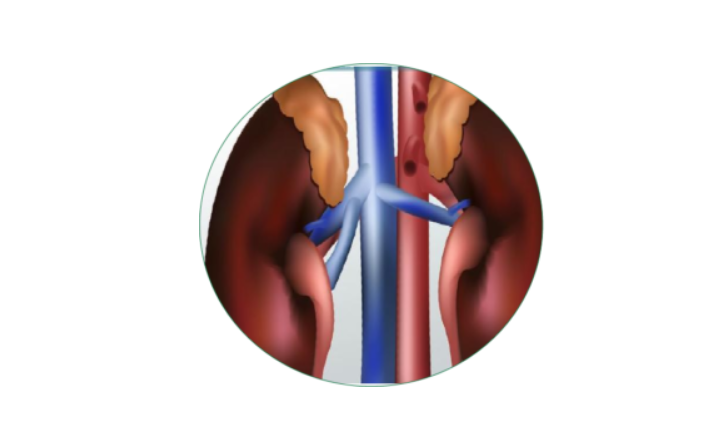 Homeopathy treatment for Nephrotic Syndrome in Dubai