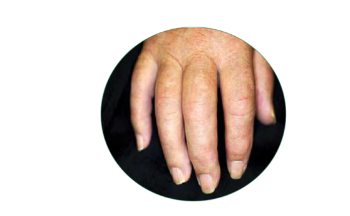 Homeopathy treatment for Psoriatic Arthritis in Dubai