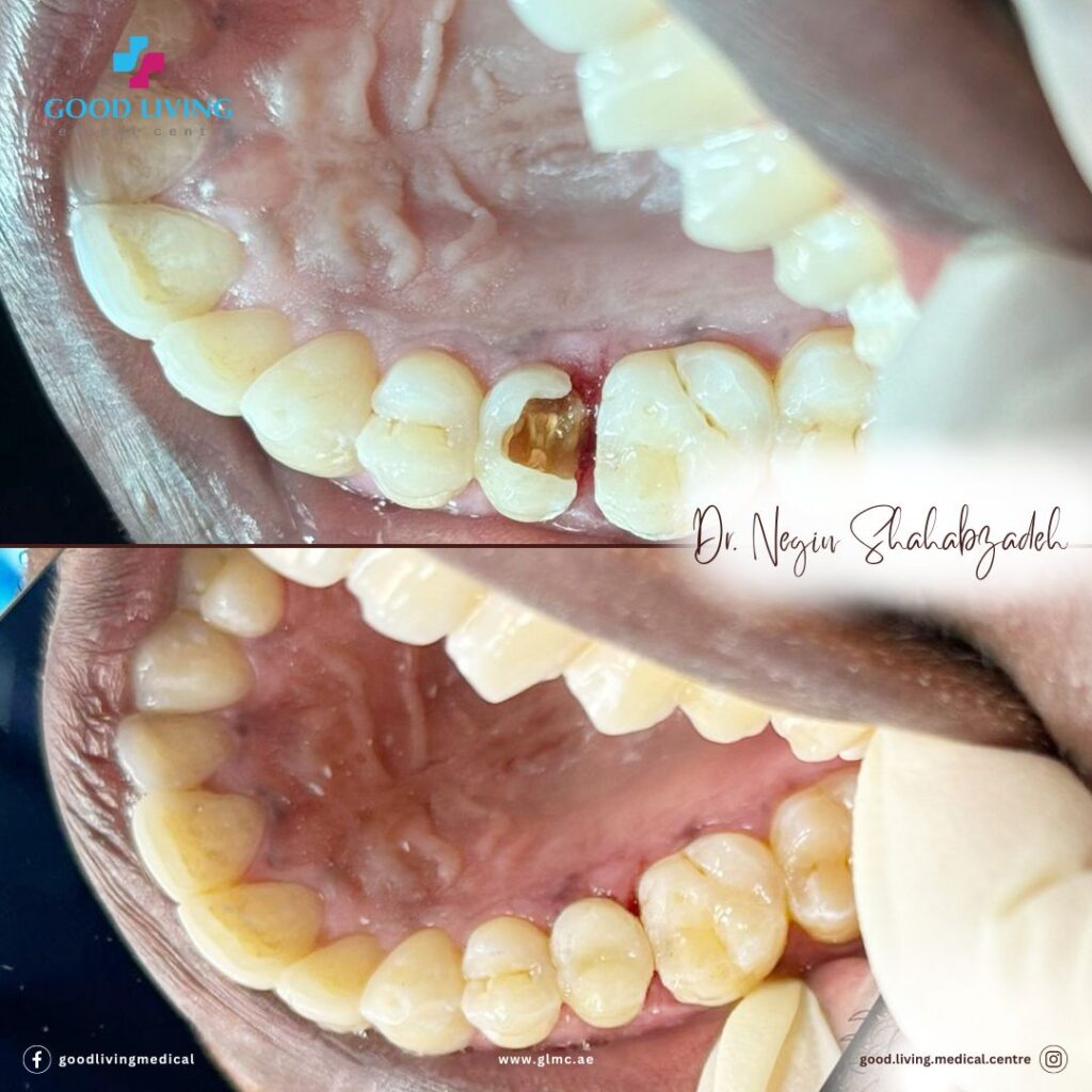composite filling, dental filling, before and after images, good living medical centre