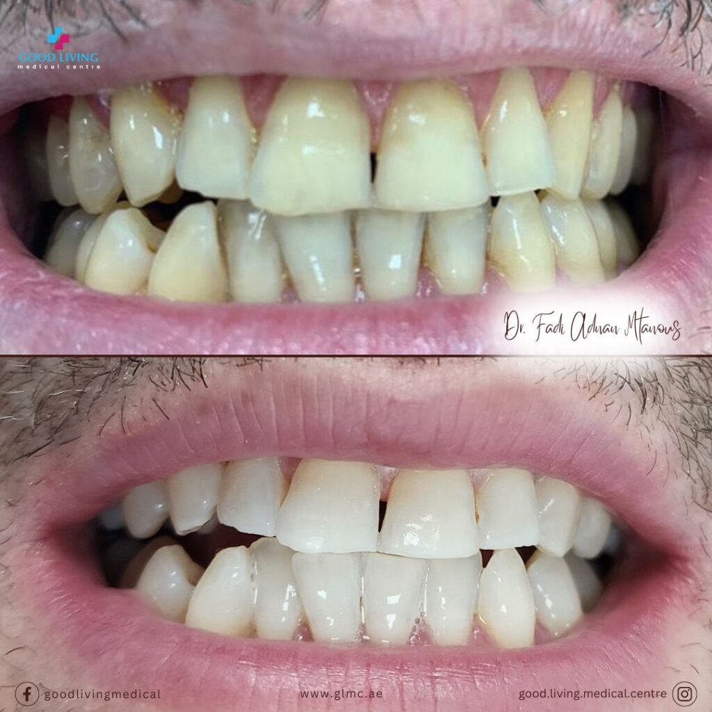 zoom teeth whitening, teeth whitening, beyond teeth whitening, teeth whitening in dubai, cosmetic dentistry