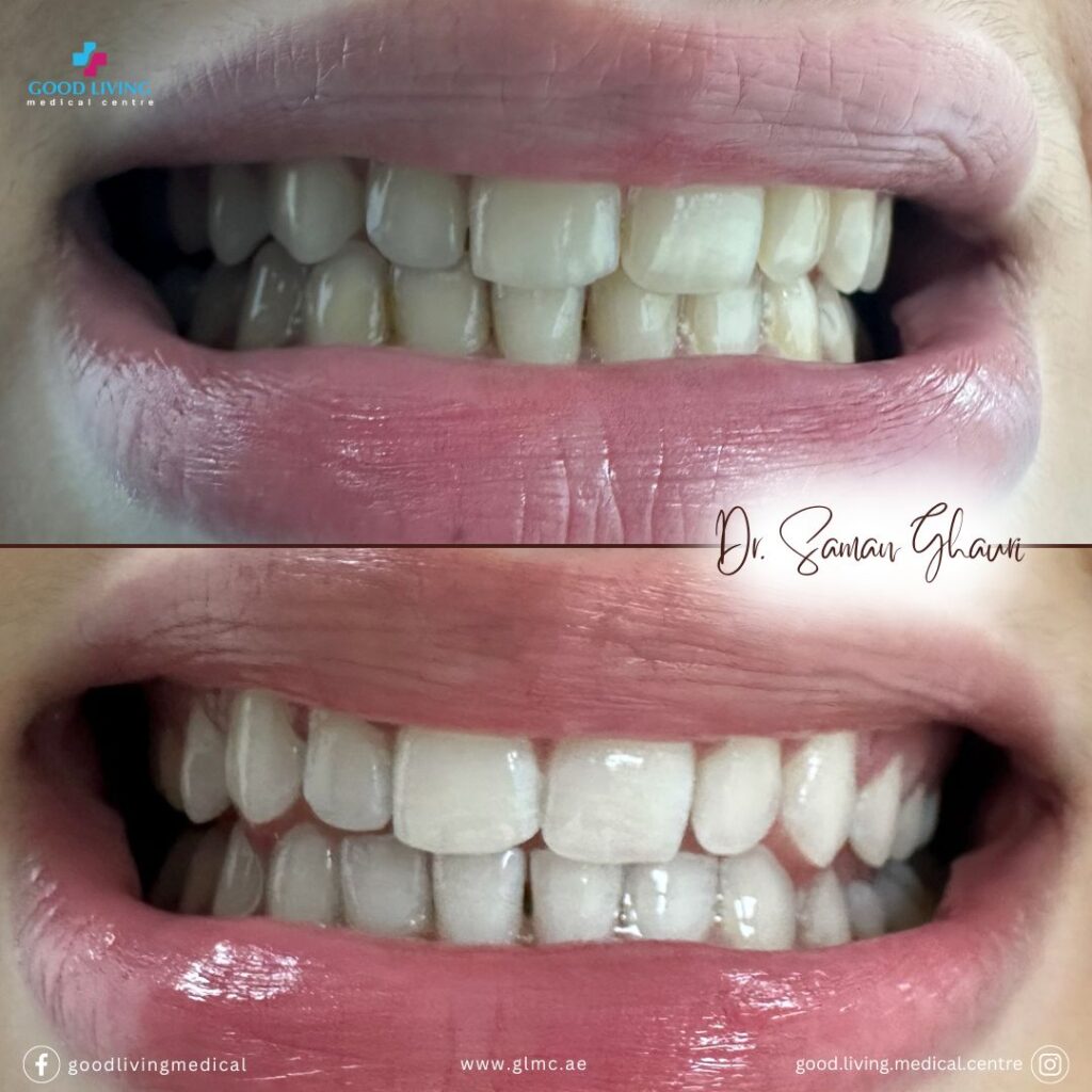 Teeth whitening, teeth whitening in dubai, zoom teeth whitening, beyond teeth whitening, cosmetic dentistry