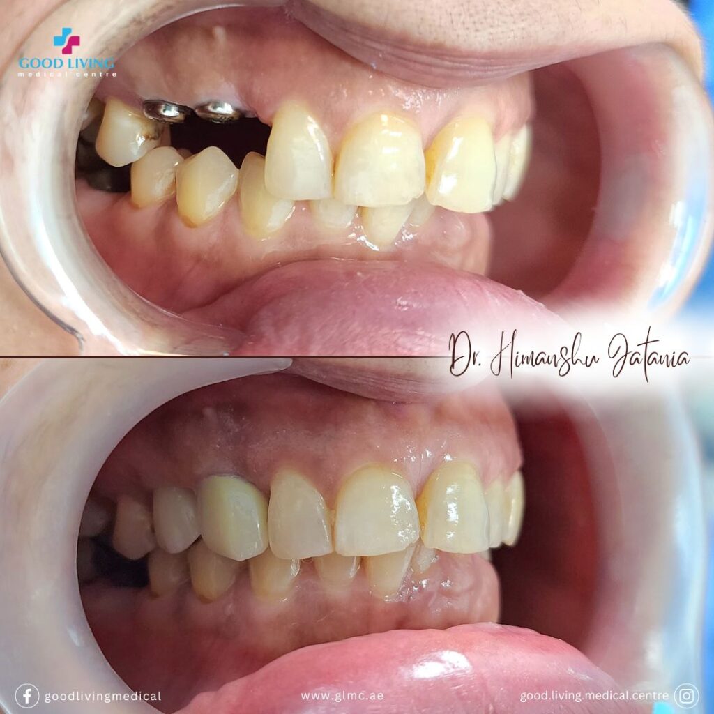 Dental implants, dental implant clinic in dubai, best dental clinic in dubai