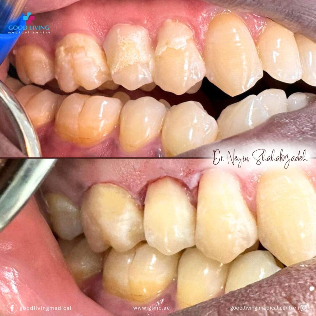 dental filling, cavities, before and after, best dental clinic in dubai, composite filling, good living medical centre
