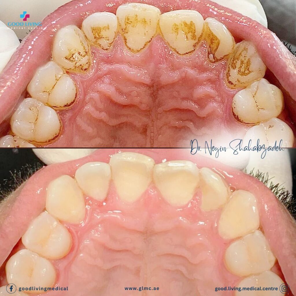 Dental scaling and polishing, dental cleaning, general desntistry, dental clinic in dubai, best dental clinic in dubai, good living medical centre