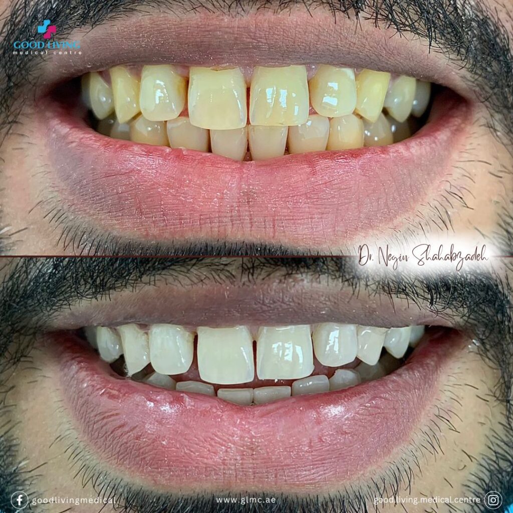 Zoom teeth whitening, teeth whitening, beyond teeth whitening, teeth whitening in dubai, cosmetic dentistry