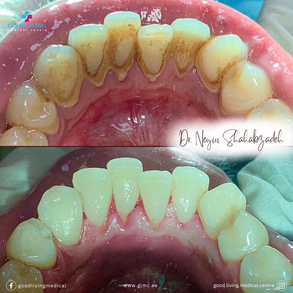 Dental scaling and polishing, dental cleaning, general desntistry, dental clinic in dubai, best dental clinic in dubai, good living medical centre