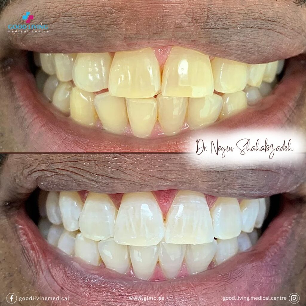 teeth whitening, zoom teeth whitening, beyond teeth whitening, teeth whitening in dubai, cosmetic dentistry