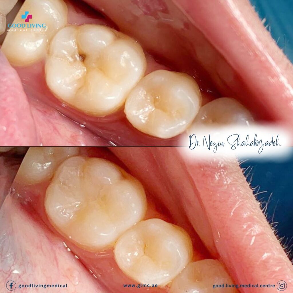 dental filling, cavities, before and after, best dental clinic in dubai, good living medical centre