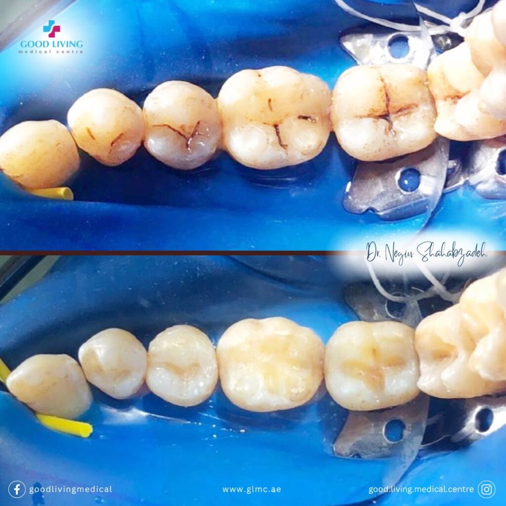 dental filling, cavities, before and after, best dental clinic in dubai, composite filling, good living medical centre
