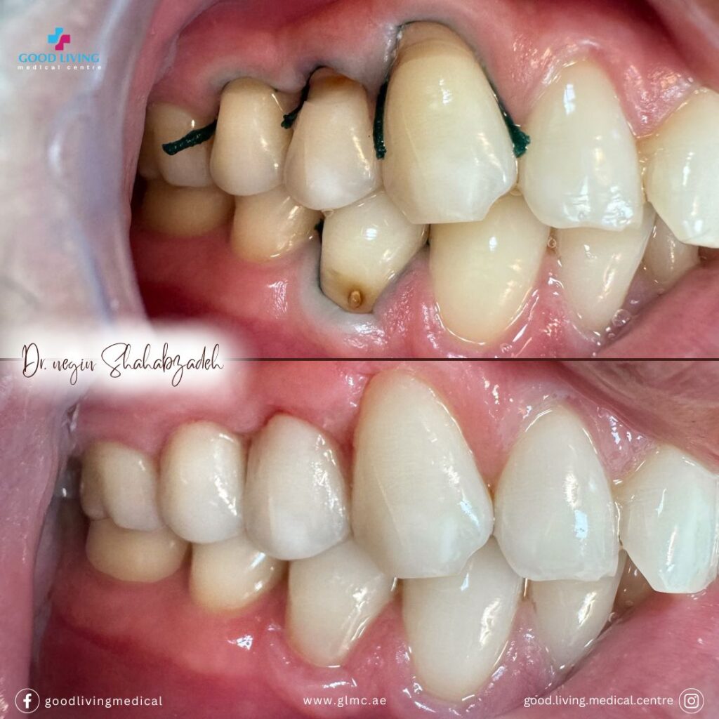 composite filling, dental filling, before and after images, good living medical centre