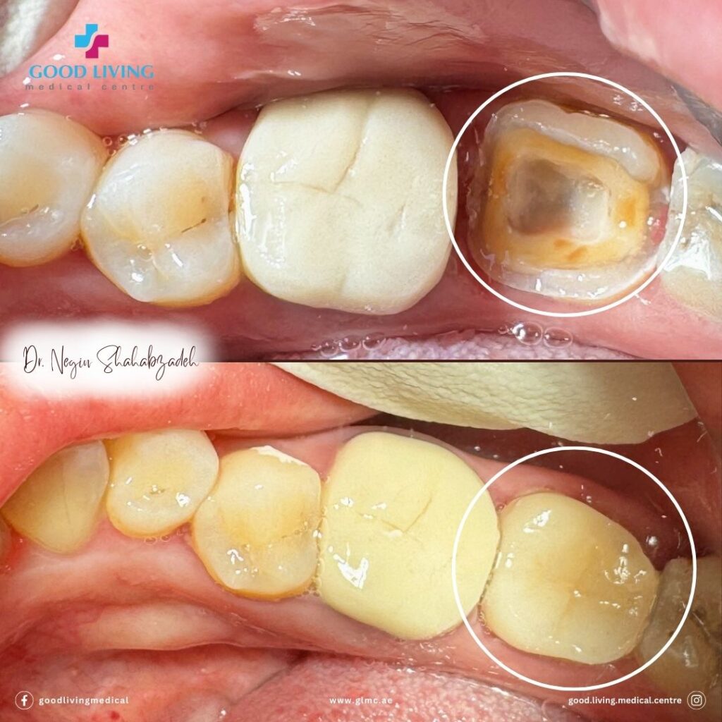 zirconia crown, General dentistry, before and after treatment, best dental clinic in dubai, dental clinic in dubai, good living medical centre