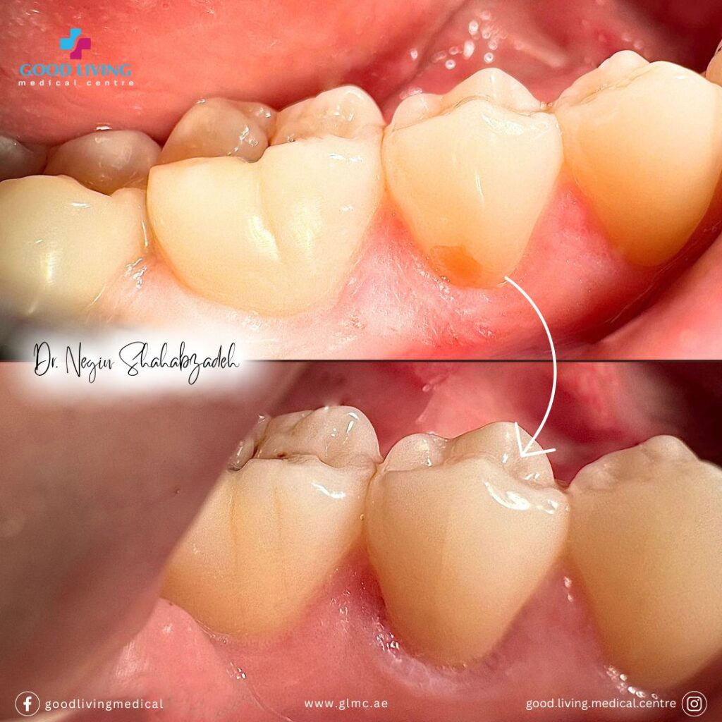 cervical abrasion, bruxism, composite filling, before and after, best dental clinic in dubai, general dentistry
