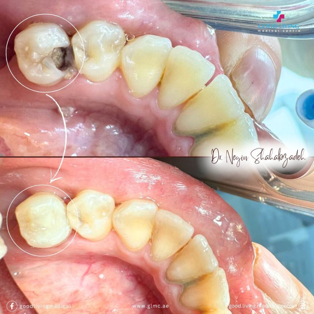 composite filling, before and after treatment, general dentistry, best dental clinic in dubai, clinic in dubai, good living medical centre